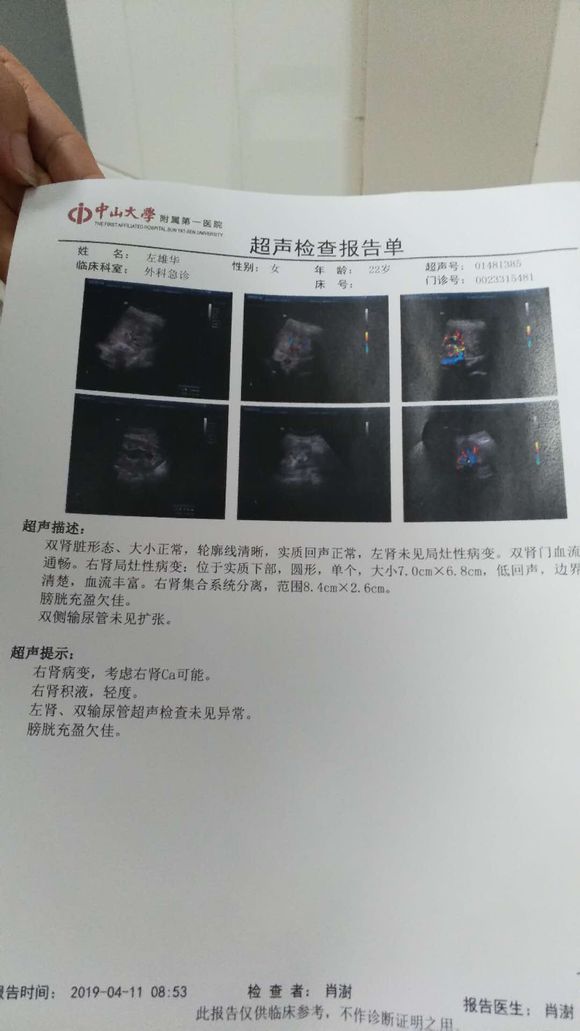 有肾癌的朋友们进来看下,这是什么期的万分感谢